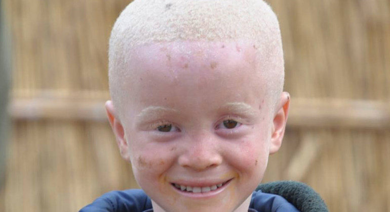 Naciones Unidas promueve el honor de ser albino